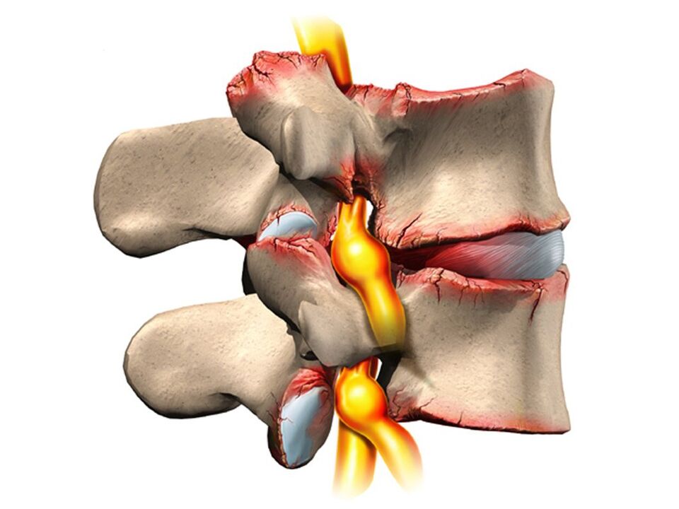 poškodbe hrbtenice z osteohondrozo