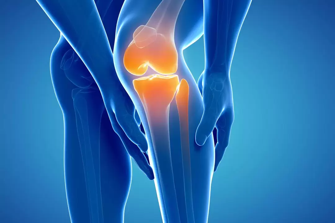 Artroza kolenskega sklepa (gonartroza, deformirajoči osteoartritis)