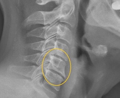 Osteohondroza vratne hrbtenice na rentgeni