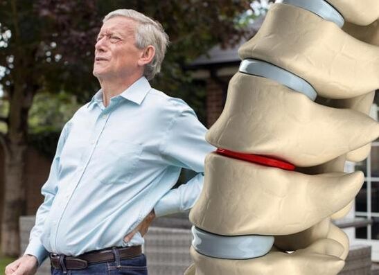 Osteohondroza vpliva na medvretenčne ploščice in povzroča bolečine v hrbtu